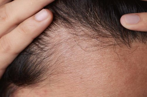 درمانی جدید برای ریزش مو