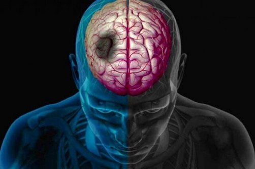 ترکیبات طبیعی، امید تازه در کاهش آسیب‌های سکته مغزی