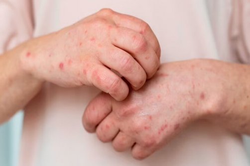 پاییز؛ فصل بروز علائم سالک / «تب شالیزار» چیست؟ 