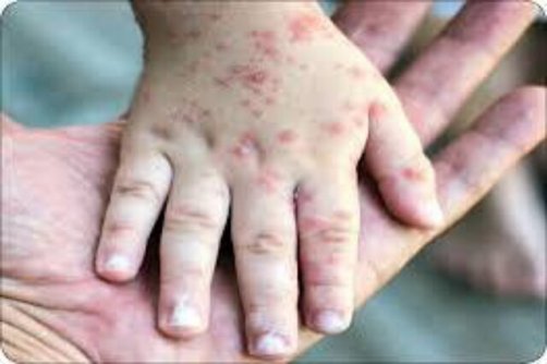 عوارض بروز آبله‌مرغان در بزرگسالی / توصیه تزریق واکسن در گروه‌های پرخطر