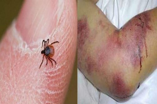 اوج فعالیت کنه‌ها در فصل گرما / توصیه وزارت بهداشت برای پیشگیری از «تب کریمه کنگو»