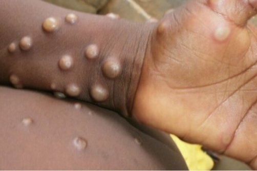  شناسایی موارد جدید ابتلا به آبله میمون در جهان شناسایی موارد جدید ابتلا به آبله میمون در جهان 